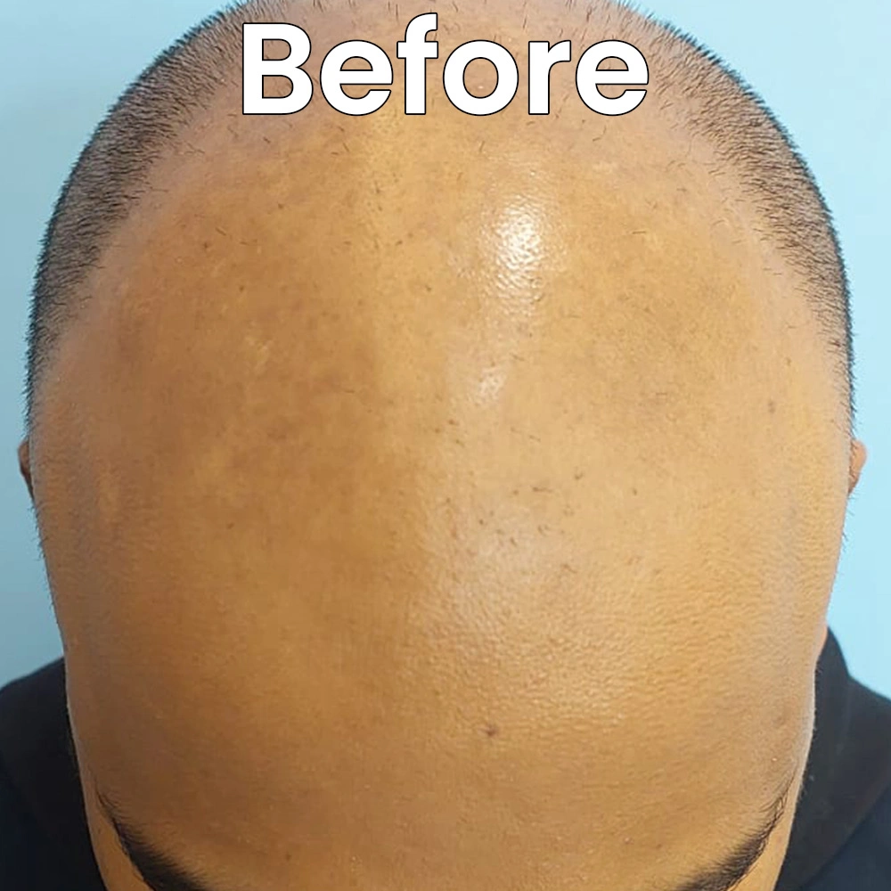 Hair loss before SMP Delhi