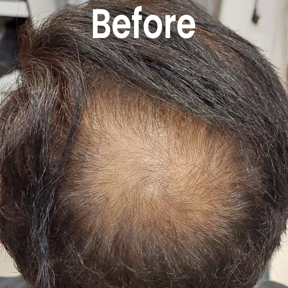 Scalp micropigmentation before Delhi