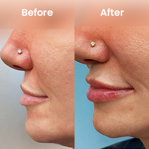 Volume enhancement before and after