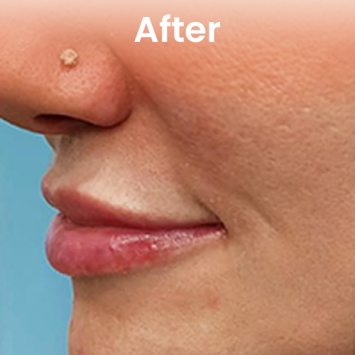 After volume enhancement treatment