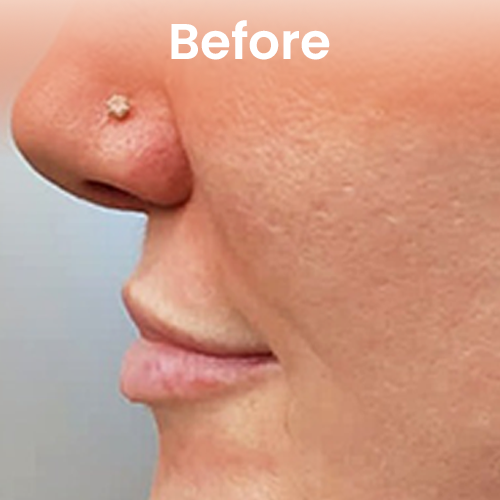 Before volume enhancement treatment