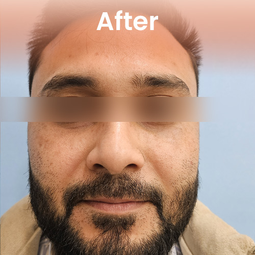 After under eye filler Treatment
