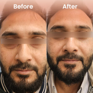 Under-eye treatment before and after – reduced dark circles and puffiness