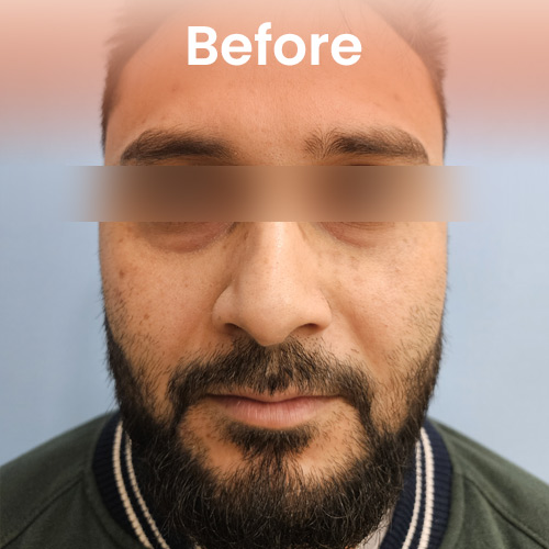 Before under eye filler Treatment