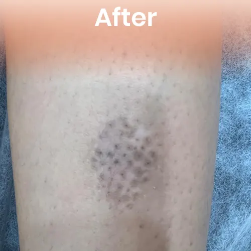 After vitiligo treatment Delhi