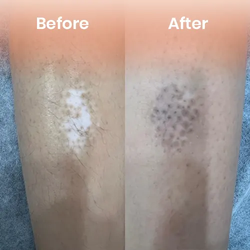 Vitiligo treatment before after