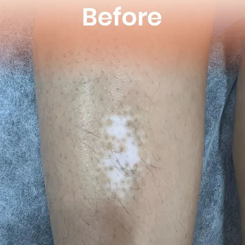 Before vitiligo treatment Delhi
