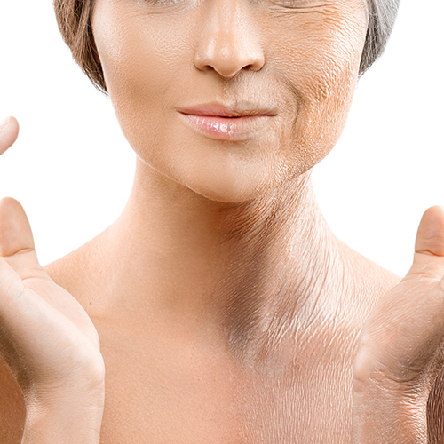 Wrinkle reduction and fine line treatment