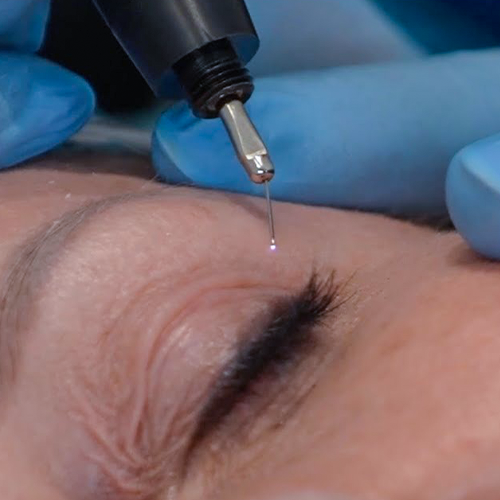 Plasma Pen healing dots