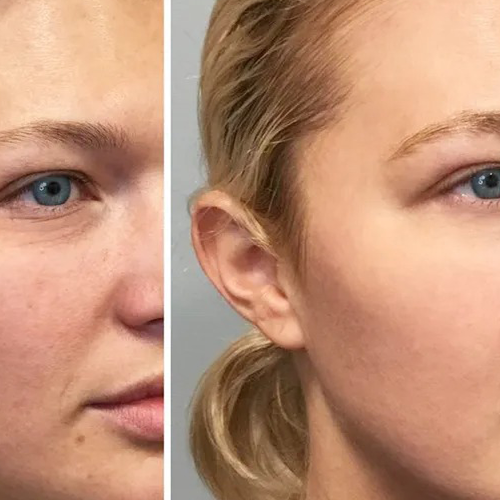 Advanced anti-aging injectables