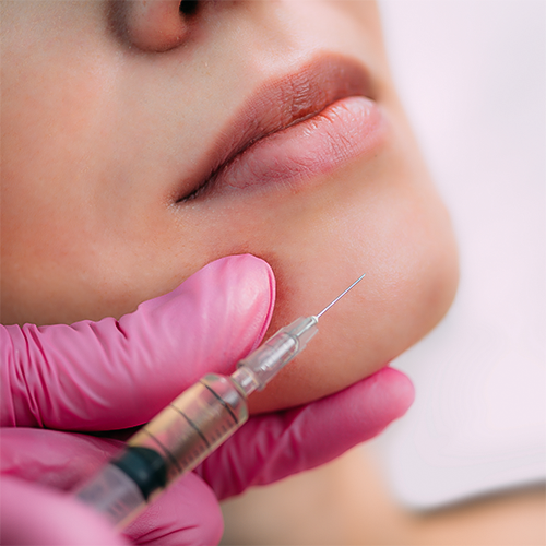 Jawline enhancement with dermal fillers