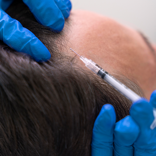 PRP hair restoration results – visible hair growth and scalp health improvement