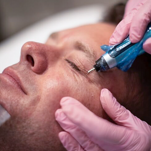 Plasma Pen for wrinkles
