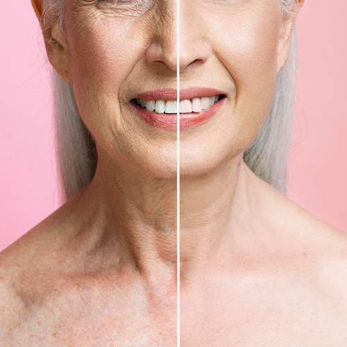 Non-surgical anti-aging treatment