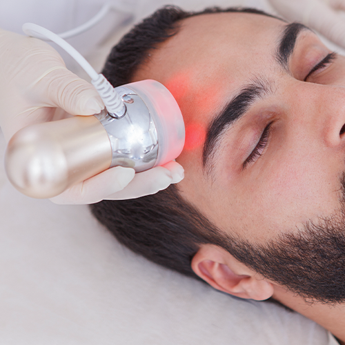 Visible MNRF results – youthful skin texture after RF microneedling