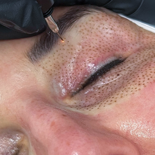 Under-eye Plasma Pen results