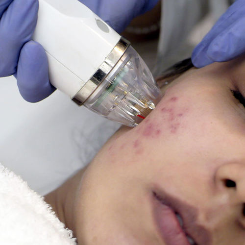 Look Young Clinic MNRF procedure – advanced skin lifting and firming treatment