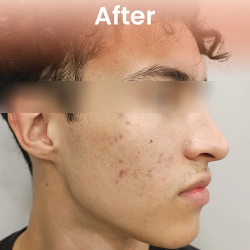 After cool jet plasma treatment