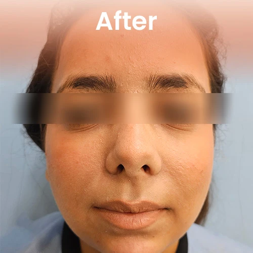 After dermal filler treatment – smooth, youthful skin with enhanced facial contours