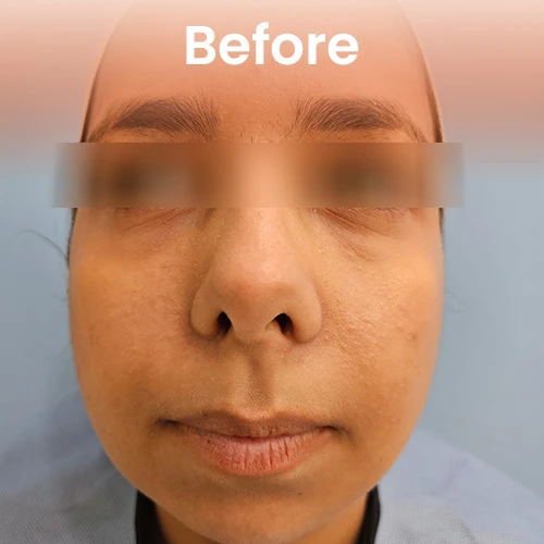 Before dermal filler treatment – visible facial lines and volume loss