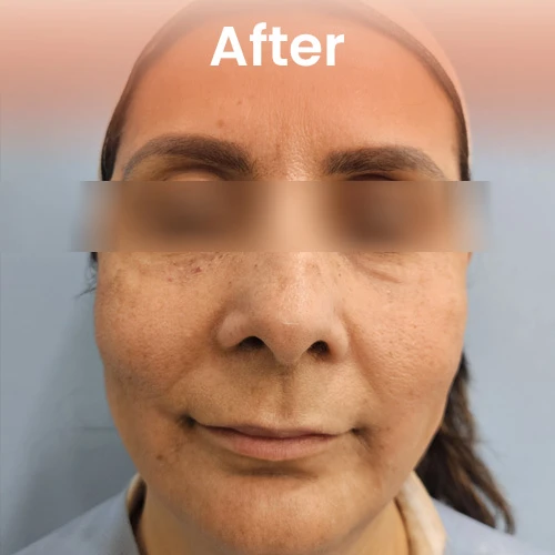 After HIFU treatment