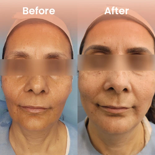HIFU treatment before and after