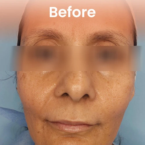 Before HIFU treatment