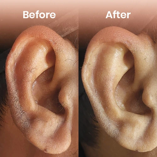 Before and after permanent hair reduction – laser hair removal results