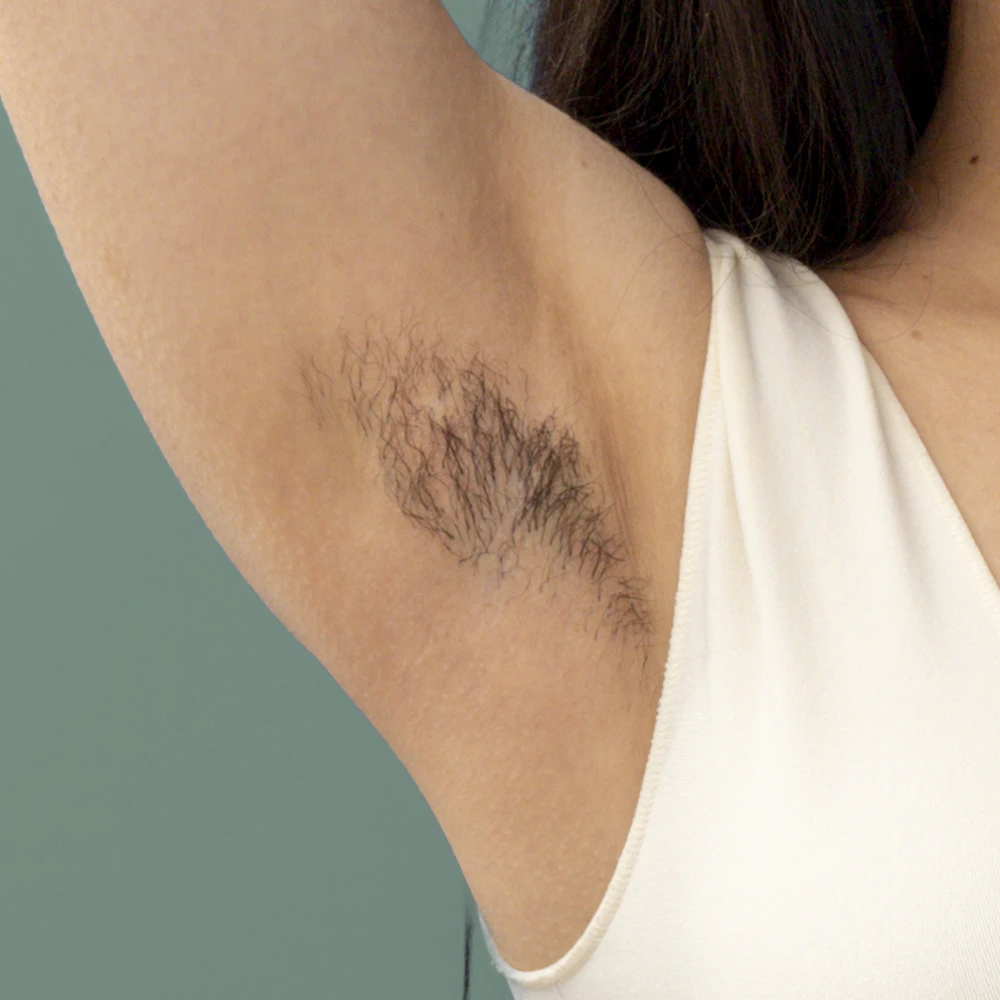 Arm Unwanted Hair Removal