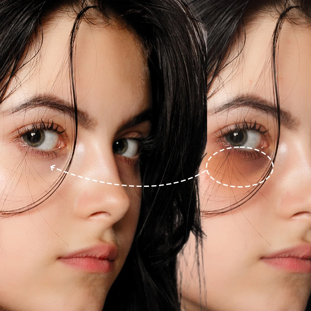 Dark Circles Under Eye Treatment in Delhi