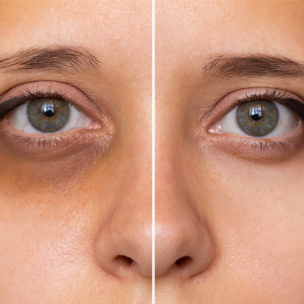 Dark Circles Treatment in Delhi