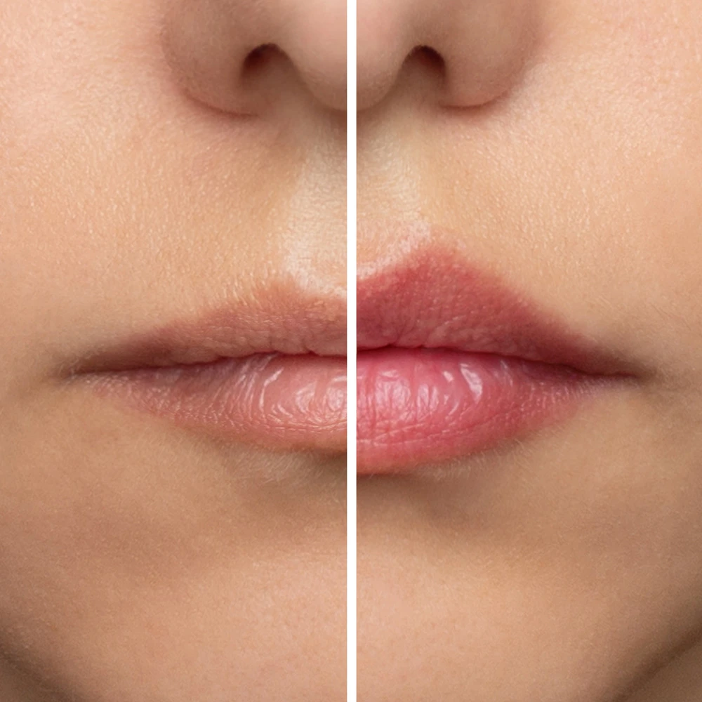 Dermal Filler Lip Augmentation Treatment