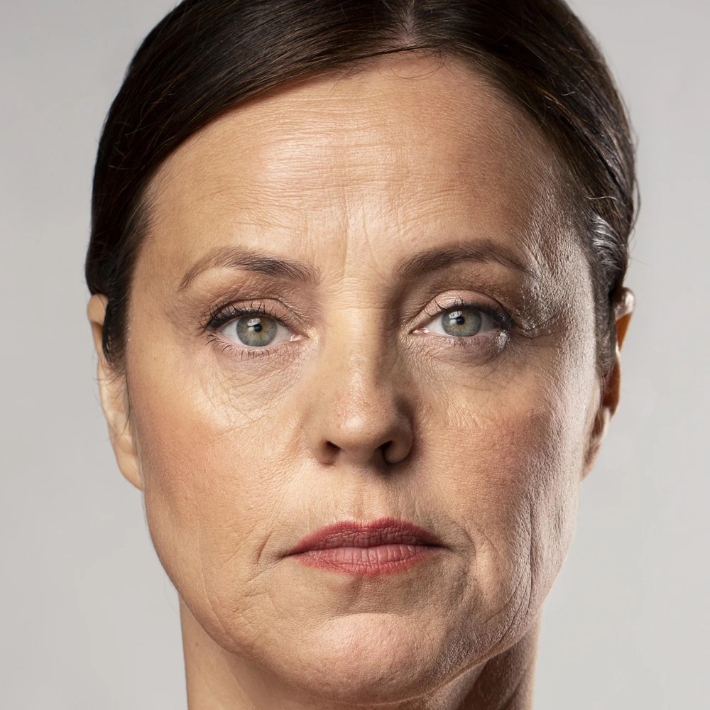 Forehead Lines Wrinkle Treatment in Delhi