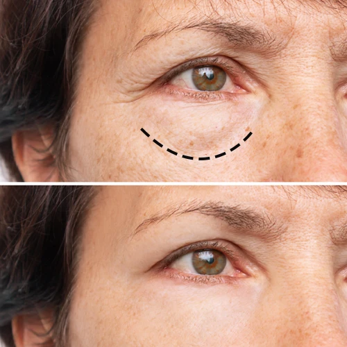 Under Eye Filler Treatment