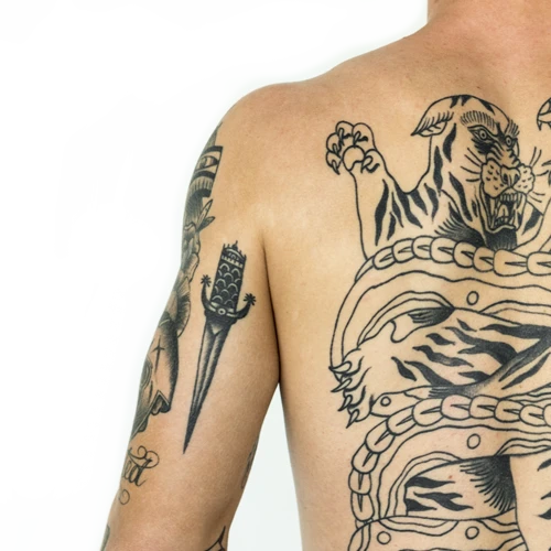 Laser Tattoo Removal Treatment