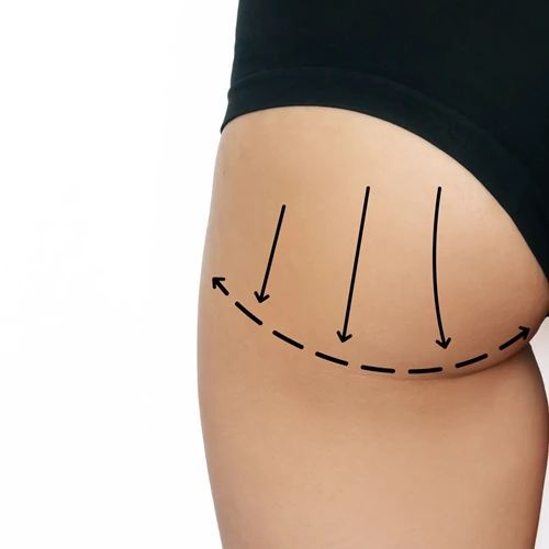 Non Surgical Butt Lift Treatment