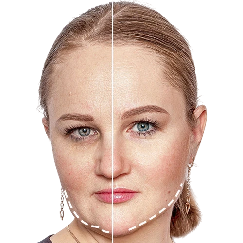 Buccal Fat Surgery