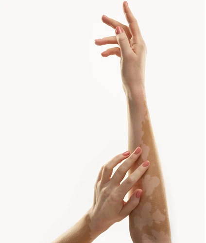 26_Vitiligo Treatment_1_500X500