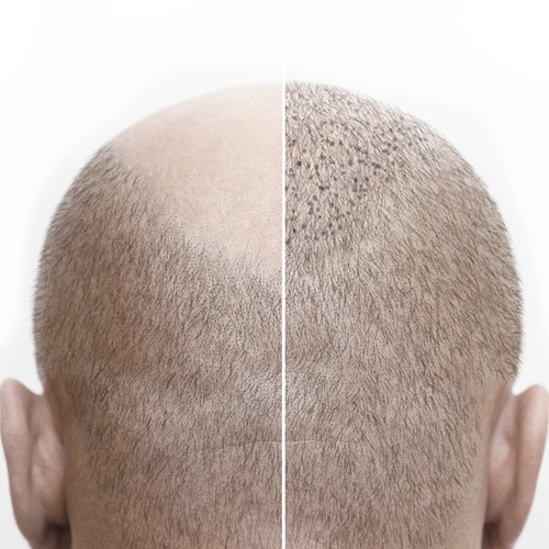 29_scalp-micropigmentation-treatment_1_500X500