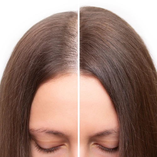 Hair Regrowth Treatment (PRP)