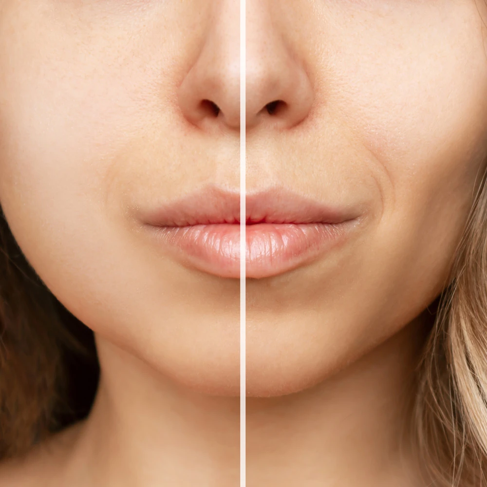 Dermal Fillers Treatment for Contouring
