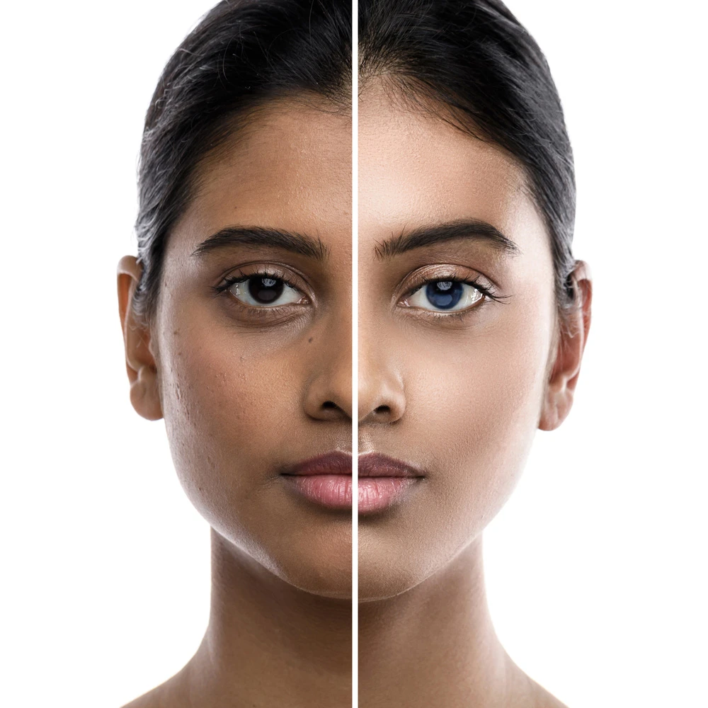 Laser Skin Treatments in Delhi