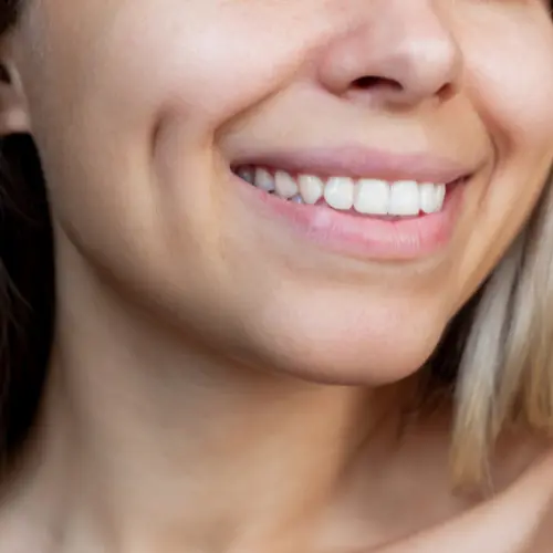 Post dimpeloplasty smiling face