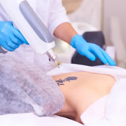 Tattoo removal with laser Delhi
