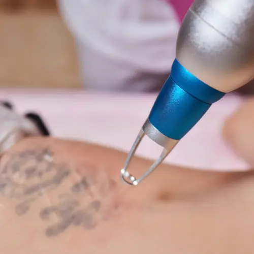 Before after tattoo removal Delhi