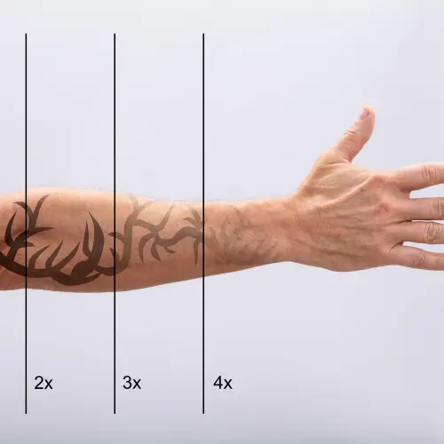 Laser tattoo removal result
