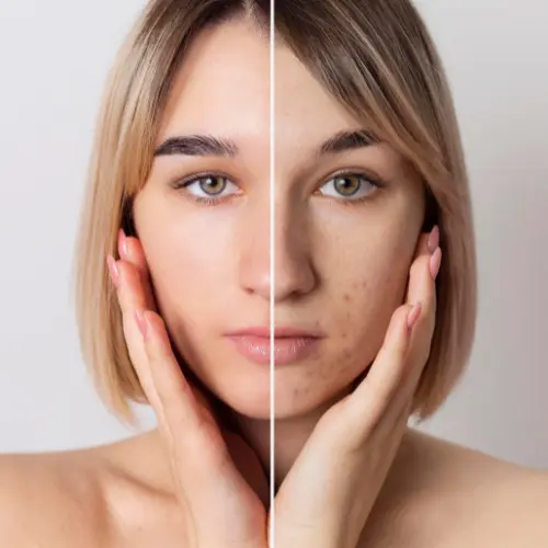 Effective acne scar removal therapy – smoother, clearer skin appearance