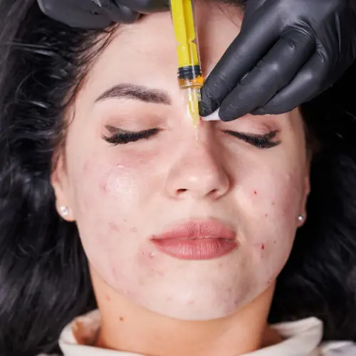 Acne scar reduction procedure – expert skin rejuvenation at Look Young Clinic