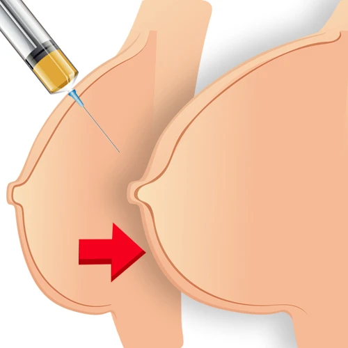 Breast fillers treatment