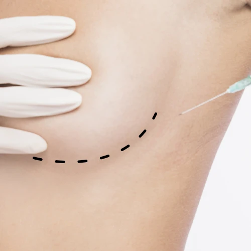 Non-surgical breast enhancement